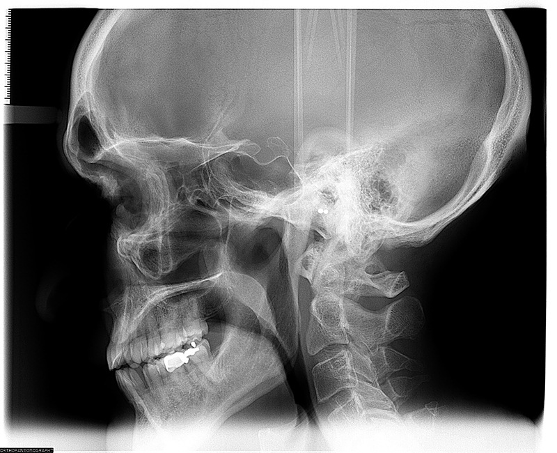 Cephalometric X-Ray Example